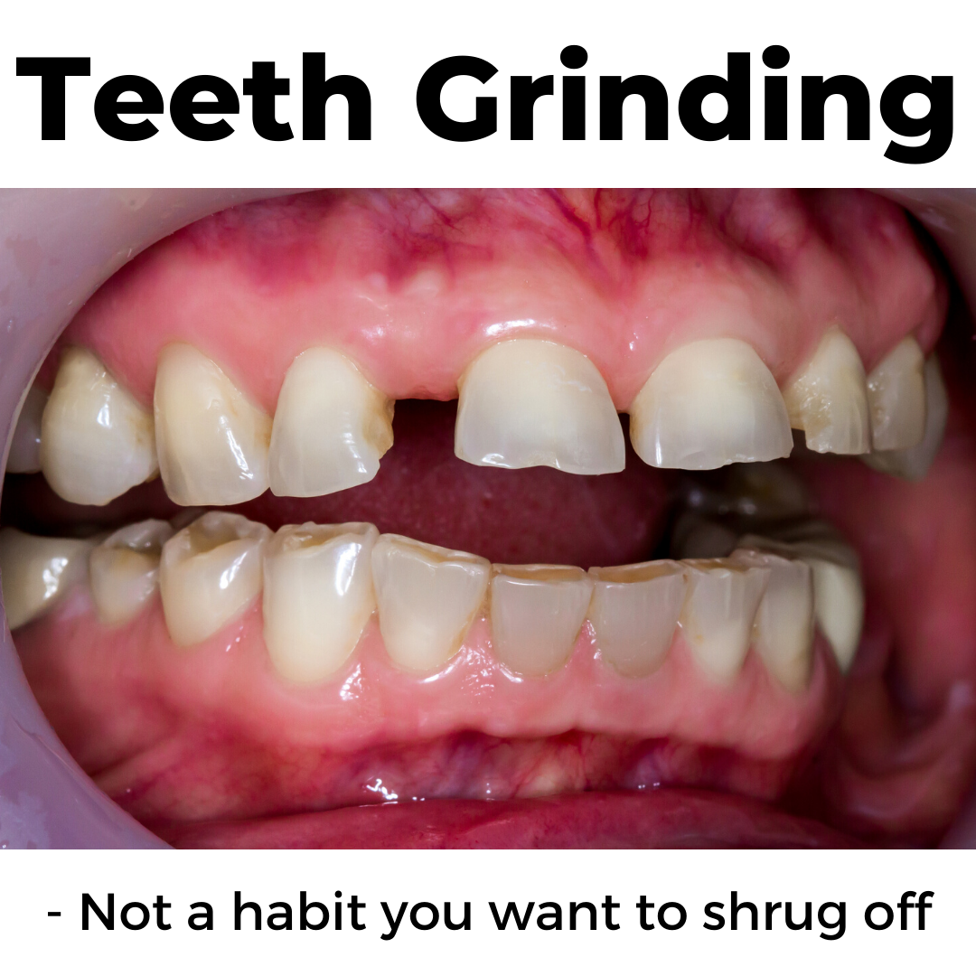 What Are The Signs Of Teeth Grinding At Rita Wells Blog